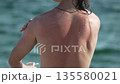 Sunscreen sunburn man applying lotion to his red back at the beach 135580021