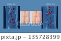 Varicose veins on a female senior legs. The structure of normal and varicose veins. Concept of dry skin, old senior people, varicose veins and deep vein thrombosis or DVT - 2D animation 135728399