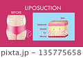 Mechanism of liposuction. Suction-assisted liposuction. Hollow tube or cannula, which is inserted through a small incision in the skin in order to fat suctioned out of the body. 3D animation 135775658