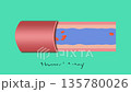Angioplasty. Stent Implantation. Deflated balloon catheter inserted into a coronary artery narrowed by plaque. the balloon is inflated, compressing the plaque against the artery wall - 2D animation 135780026