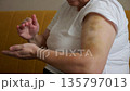 Woman With Injuries Resting On Couch, Woman With Bruised Arm Showing Signs Of Violence, Female Victim Displaying Visible Injuries On Sofa After Abusive Incident From Domestic Environment 135797013