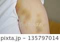 Bruised Arm With Yellow Marks, Closeup Of Upper Arm With Bruising And Discoloration, Photograph Capturing Detailed Bruising And Skin Discoloration On Upper Arm For Medical Assessment 135797014