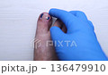 Medical pedicure treatment showing toe nail tamponade to prevent ingrown toenail. Podiatry procedure with cotton packing, antiseptic care and nail correction. 136479910