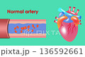 Blood Vessel Blockage Animation Caused by Cholesterol - 3D animation 136592661