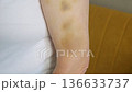 Examined Arm Injuries, Detailed View Of Bruised Arm, Focus On Upper Arm With Visible Injury Marks, Highresolution Photograph Displaying Injured Skin With Colorful Ecchymosis And Textural Details 136633737