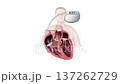 Cardiac Pacemaker Implantation with Transparent Male Chest and Detailed Heart Anatomy 3D Medical Illustration 137262729