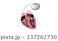 Cardiac Pacemaker Implant 3D Medical Illustration Showing Heart Anatomy with Leads and Implantable Pulse Generator 137262730