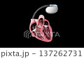 Implantable Cardiac Pacemaker Device Inside Human Heart 3D Render for Arrhythmia and Bradycardia Treatment 137262731