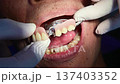 4K Dentist is applying dentures in elderly 137403352