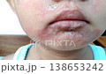 Seborrheic dermatitis on little boy face. dermatitis is a common skin disease that can come in the form of a red and swollen rash. 138653242