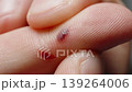 Blood under the skin on a finger, macro. Man pinched his finger. 139264006