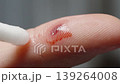 Man moistens a wound on his finger with hydrogen peroxide solution, killing harmful microbes and disinfecting it. 139264008