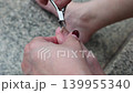 Close up trimming bruised toenail with nail clippers 139955340