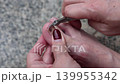 Close up nail care process for bruised toenail with dark discoloration 139955342
