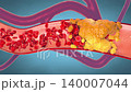 Narrowing artery from plaque buildup, restricting blood flow and raising heart risk - 3d illustration 140007044
