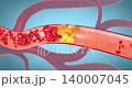 Narrowing artery from plaque buildup, restricting blood flow and raising heart risk - 3d illustration 140007045