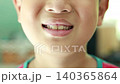 4K close up of Asian boy mouth smiling showing crooked front teeth and dry chapped lips, child dental health care problem, malocclusion and orthodontic concept, pediatric dentistry. 140365864