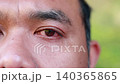 4K close up of Asian man with red bloodshot eye, conjunctivitis or pink eye irritation symptom, male painful inflamed eyeball blinking outdoor, medical ophthalmology health care concept. 140365865