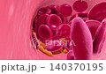 Plaque buildup in an artery narrows blood flow and can trigger clots that block the vessel completely 140370195