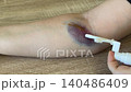 sizzling spraying liquid medicine on human skin 140486409