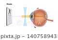 Myopia Correction Animation Nearsightedness Vision Disorder, Concave Lens Refraction, Human Eye Anatomy, Ophthalmology, Optometry, Medical Education, 2D and 3D Animation 140758943