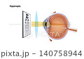 Hyperopia Vision Correction Animation Farsightedness Eye Anatomy, Convex Lens Refraction, Ophthalmology Medical Diagram, Human Eye Focus Mechanism, Optometry Education 2d 140758944
