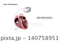 3D Animation of Biventricular Pacemaker Treatment for Heart Failure, Cardiac Care Diagram, Medical Implant Illustration, Ventricular Pacing Technology 140758951
