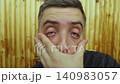 Close up portrait of a young man with dark circles and bags under eyes. Male face before blepharoplasty surgery, showing tired look, swelling and skin aging signs. Close up portrait of a young man with dark circles and bags under eyes. Male face before blepharoplasty surgery, showing tired look, swelling and skin aging signs. 140983057