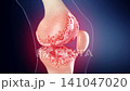 Severe bone spurs in the knee joint cartilage damage the articular surface, causing pain, stiffness, and limited mobility. 3D animation of degenerative joint disease and osteophyte formation. 141047020