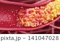 Drug molecules travel through the bloodstream to dissolve thrombi and clear vascular blockages, treating atherosclerosis and restoring blood flow. 3D animation of cardiovascular and stroke prevention. 141047028