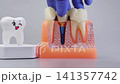 Dental Implant Crown and Bridge Removal on Jaw Model 141357742