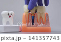 Educational demonstration of implant-supported tooth replacement, prosthodontics and restorative dentistry on a clean background. 141357743