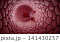 Dislodged thrombus travels through the bloodstream, blocking cerebral or coronary arteries, leading to stroke and heart attack.  Thromboembolism and cardiovascular disease progression.3D animation. 141430257