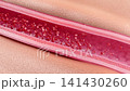 Atherosclerosis develops within the vessel wall, with lipid deposition and plaque buildup visible in cross section, narrowing the lumen and causing red blood cell blockage. 3D medical animation. 141430260