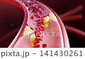 Atherosclerotic plaque ruptures in a blood vessel, shown in cross section, causing red blood cell accumulation and blockage, leading to stroke and heart attack. 3D medical animation of cardiovascular  141430261