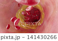 Cholesterol deposits on vessel walls cause narrowing and plaque buildup, obstructing blood flow, leading to stroke, hyperlipidemia, and vascular disease. 3D medical animation. 141430266