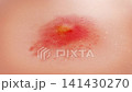 Skin surface cells regenerate to repair damaged tissue, reducing redness, swelling, acne, inflammation, and itching. Anti inflammatory treatment for dermatitis and eczema on a female arm. 3D rendering 141430270