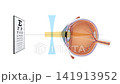 Myopia Eye Correction Medical Animation Nearsighted Vision, Concave Lens Optics, Human Eye Structure, Vision Care, Ophthalmology Training, 2D and 3D Educational Animation 141913952