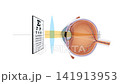 2D Hyperopia Correction Animation Farsightedness Vision Defect, Convex Lens Refraction, Human Eye Anatomy Diagram, Ophthalmology and Optometry Educational Medical Motion Graphic 141913953
