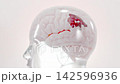 Brain damage or cancer tumor malignant cells growth and spreading. Can be used in medical elements related meningioma or neurological disease, 3D Render. 142596936