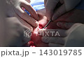 Medical Procedure Surgical Intervention on a Patients Skin for Treatment and Care. placement of the central venous port system 143019785