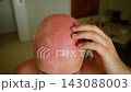 Bright red bald head with severe sunburn and irritated dry skin indoors. Male hand checking sensitive scalp after sun exposure. Skin care, summer safety and UV protection concept 143088003