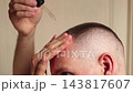 Man Applying Hair Loss Serum To Receding Hairline With Dropper. Hair Growth Treatment, Scalp Care And Daily Hair Care Routine Concept. 143817607
