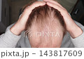 Top View Of Man Pulling Hair Back To Reveal Receding Hairline And Thinning Hair. Male Hair Loss And Baldness Concept. 143817609