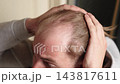 Side View Of Man Holding Hair Back To Show Receding Hairline And Thinning Hair. Male Hair Loss, Baldness And Hair Restoration Concept. 143817611
