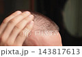 Closeup Of Man Applying Serum Drops To Scalp With Dropper. Thinning Hair, Hair Loss Treatment, Hair Growth Product And Scalp Care Concept. 143817613