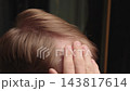 Closeup Of Man Applying Serum With Dropper To Receding Hairline. Hair Loss Treatment, Hair Growth Product, Scalp Care And Hair Restoration Concept. 143817614